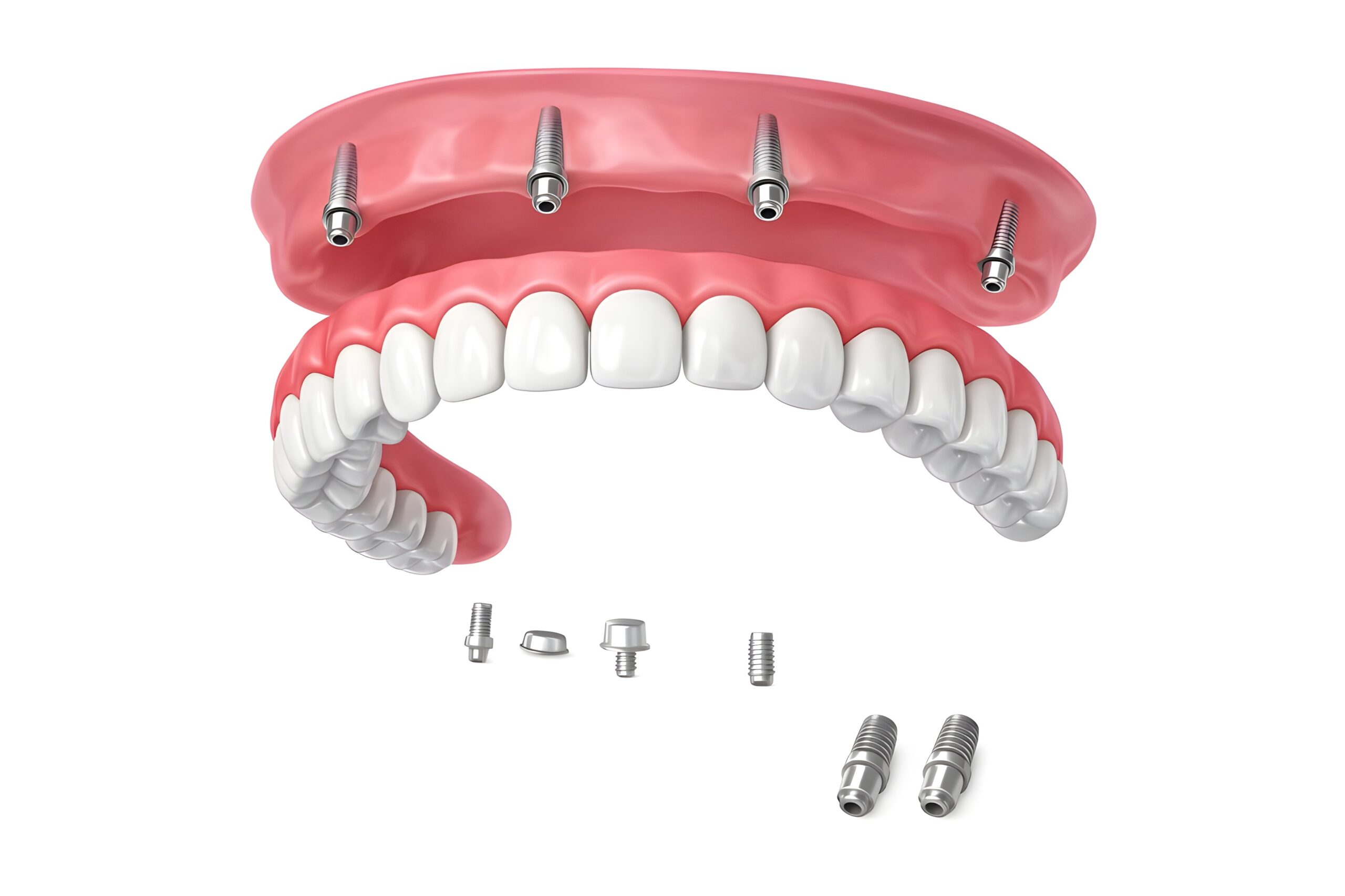 all on 4 dental implant screws and procedure