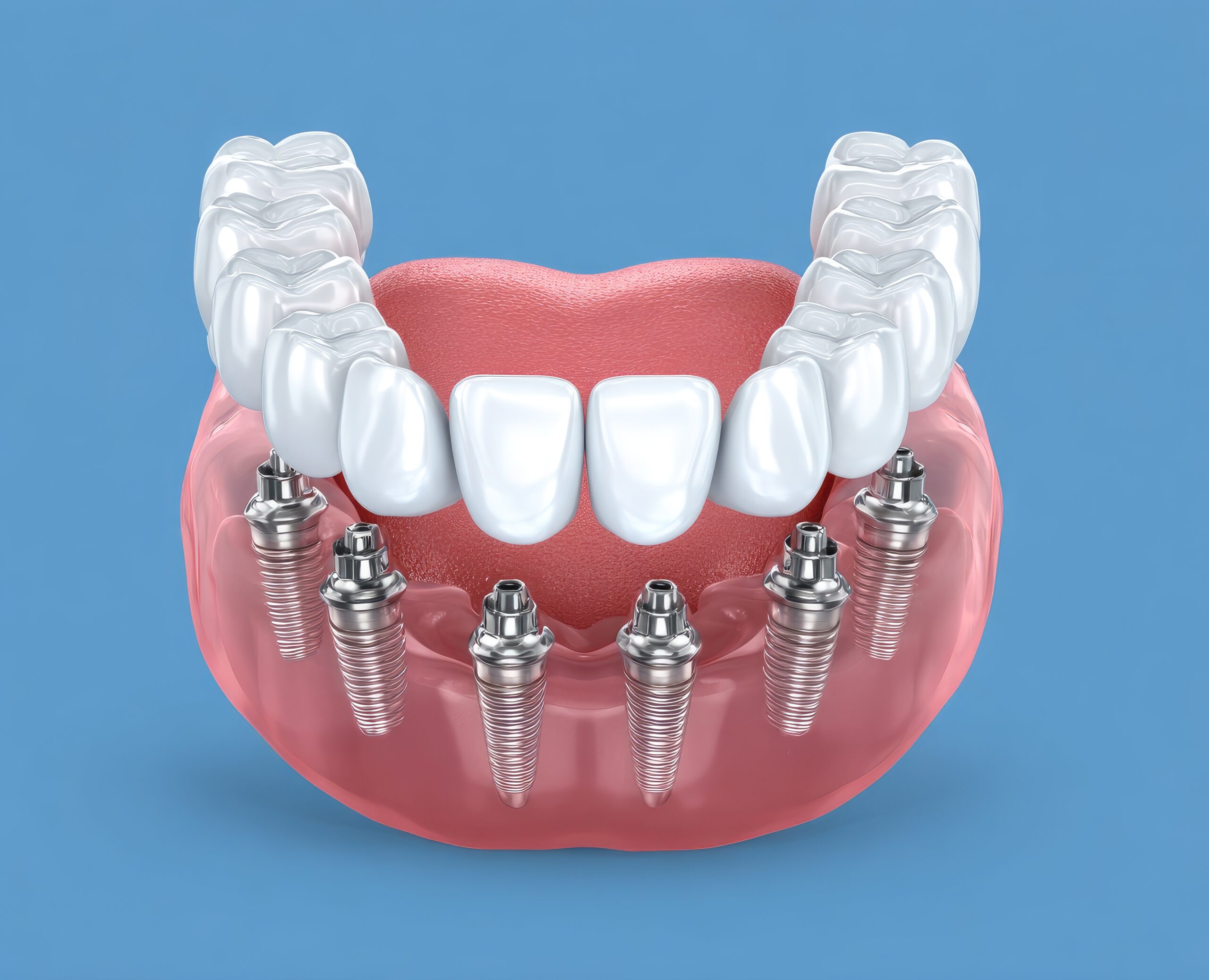 full mouth dental implants/ all on 6 dental implants at Seleit Dental