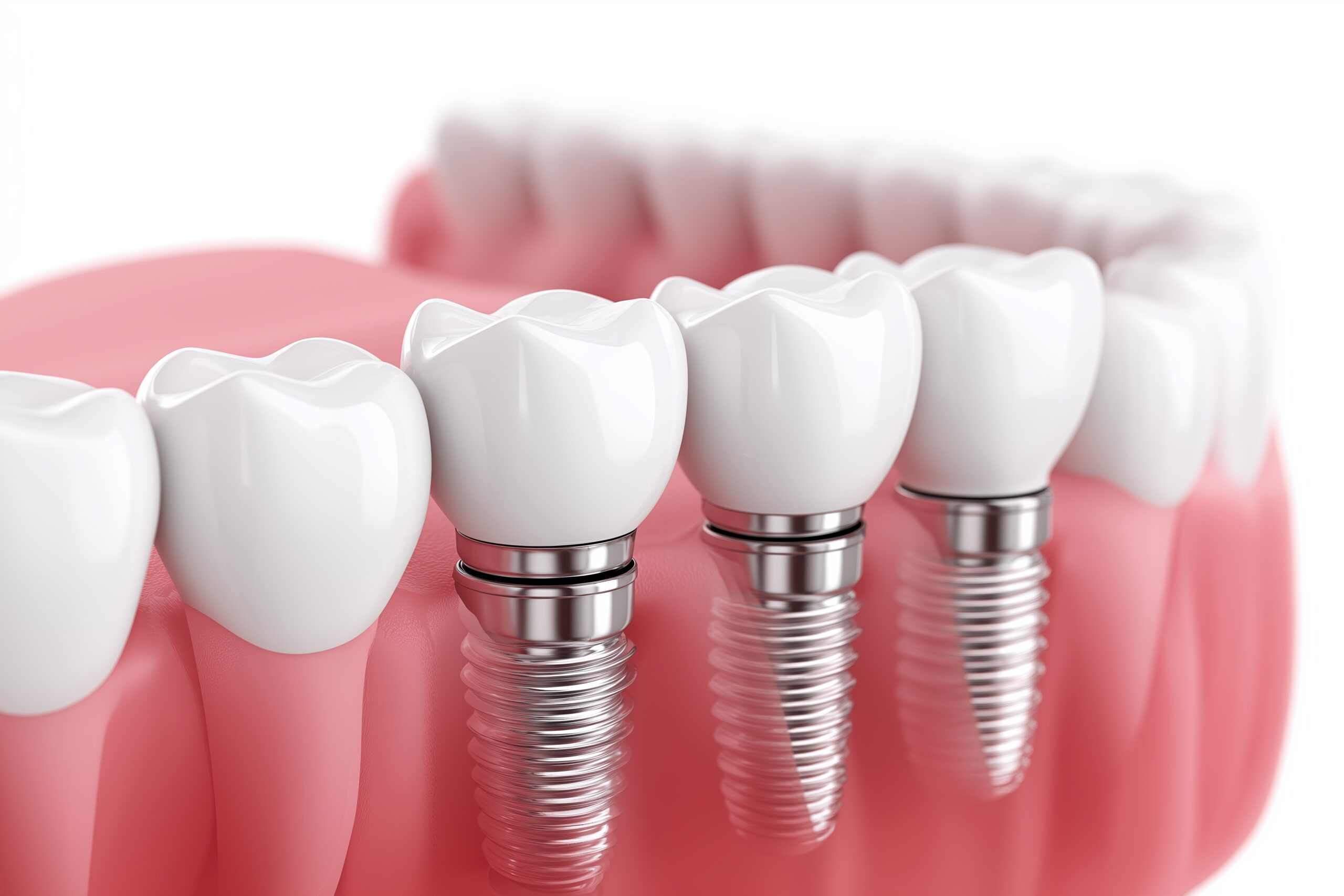 3d imagine of single tooth dental implants serviced in diamond bar CA