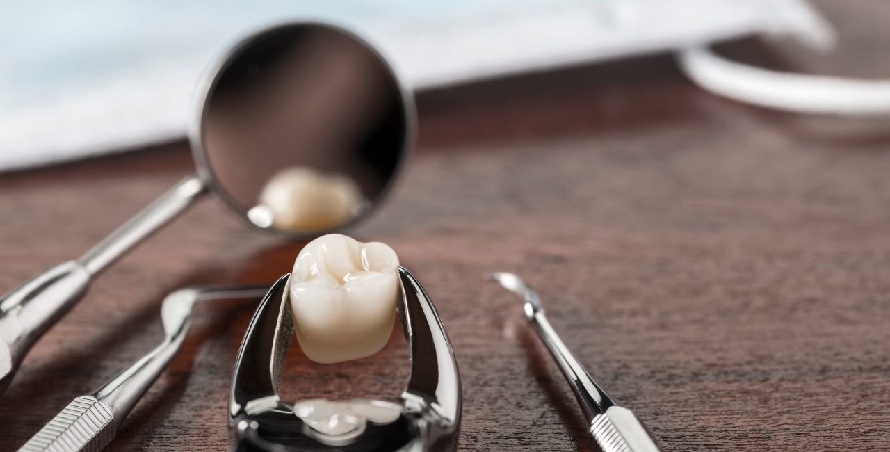 What To Do If You Need a Tooth Extraction